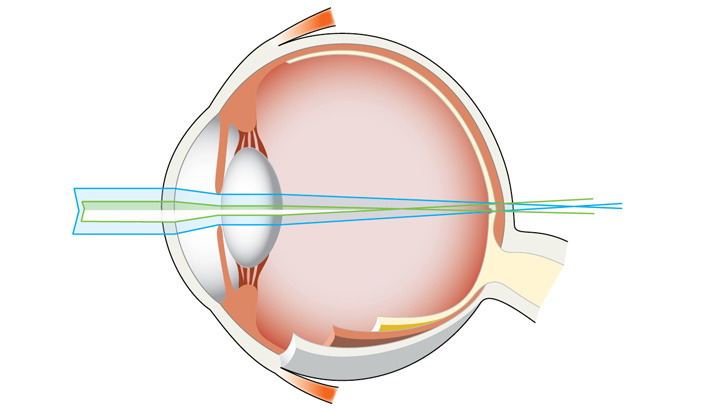 Vid astigmatism (brytningsfel) sprids ljusstrålarna ut och träffar näthinnan över ett större område.