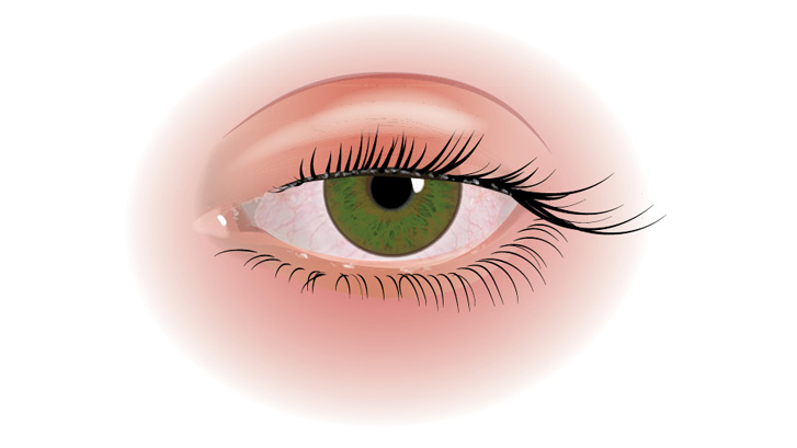 Blefarit gör ögonlockskanterna röda, irriterade och svullna.