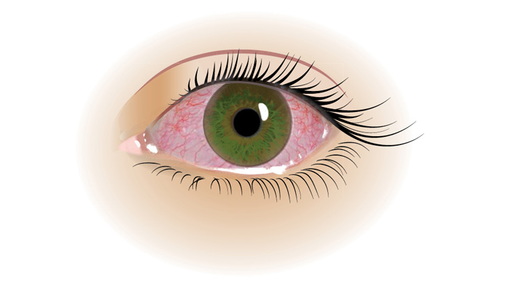 Allergisk Konjunktivit är en inflammation i ögats bindhinna som gör ögat rött och irriterat.