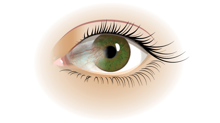 Pterygium ser ut som en rödaktig triangel som växer på ögonvitan.