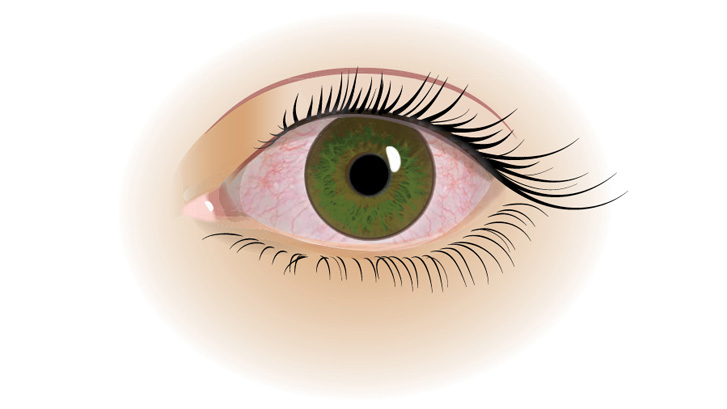 Torra ögon är ofta trötta, irriterade och rinniga.