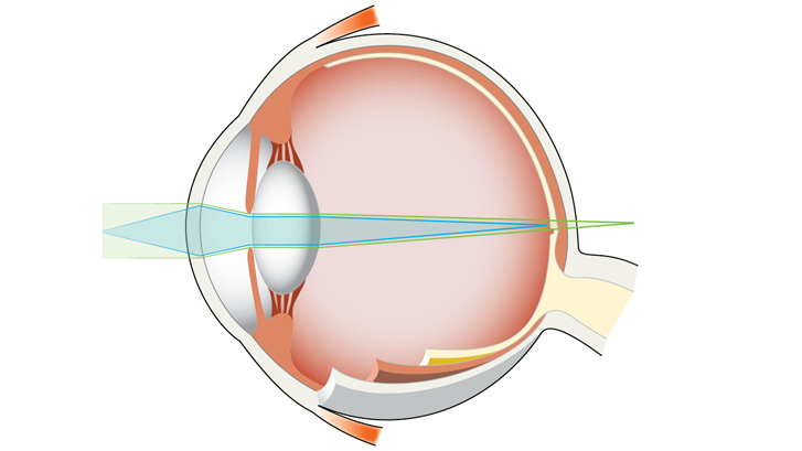 Vid ålderssynthet har linsen blivit stel och kan inte anpassa skärpan från objekt på nära avstånd.