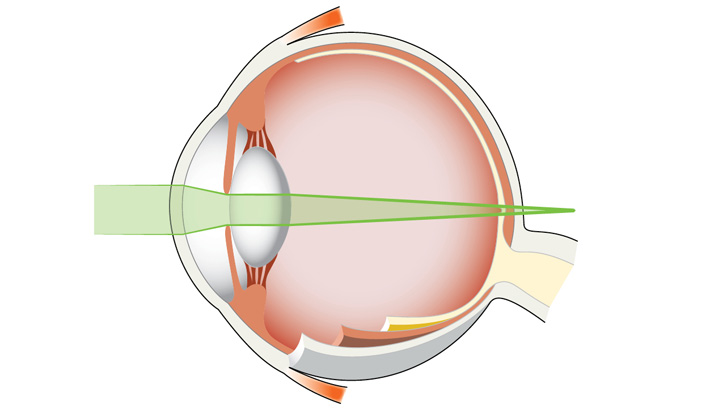 Vid översynthet bryts ljusstrålarna bakom näthinnan.