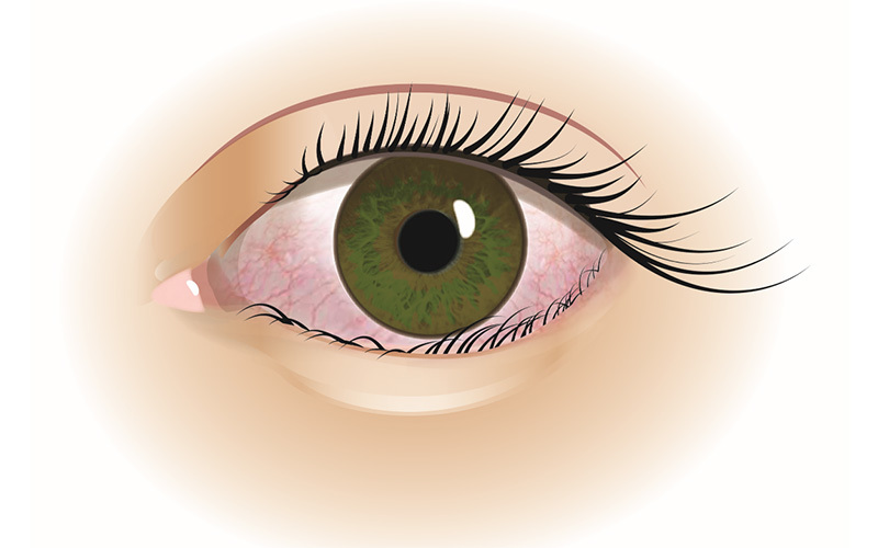 Inåtvänt ögonlock